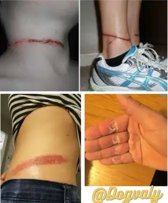 How to Treat Rope Burn from Dog Leash
